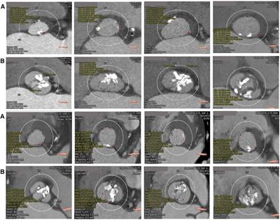 Determinants of device success after transcatheter aortic valve replacement in patients with type-0 bicuspid aortic stenosis